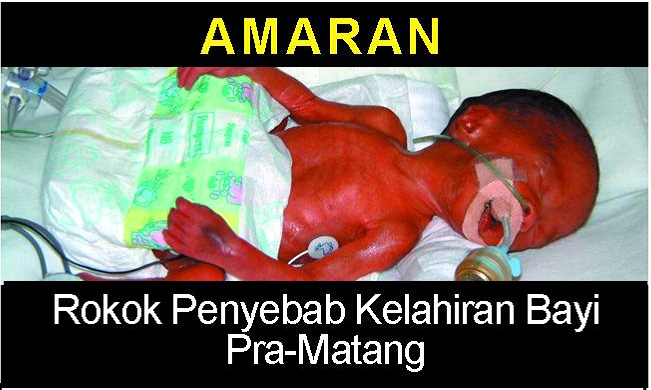 Malaysia 2008 ETS Baby - premature birth, lived experience, baby with oxygen tubes (front)